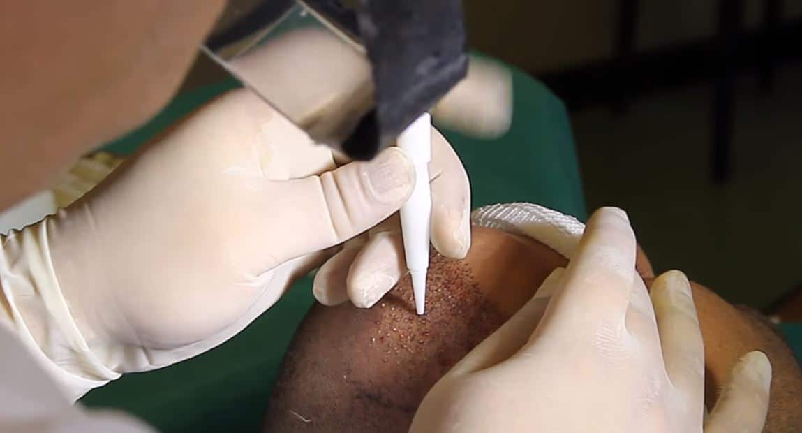 unrasierte Haartransplantation