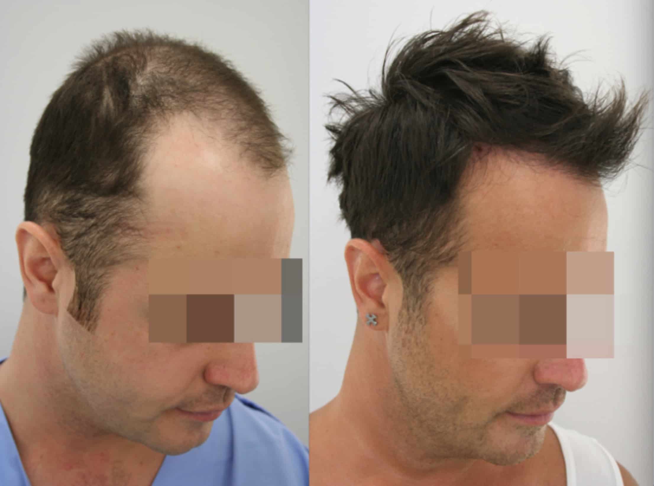 unrasierte Haartransplantation vor nach dem Foto