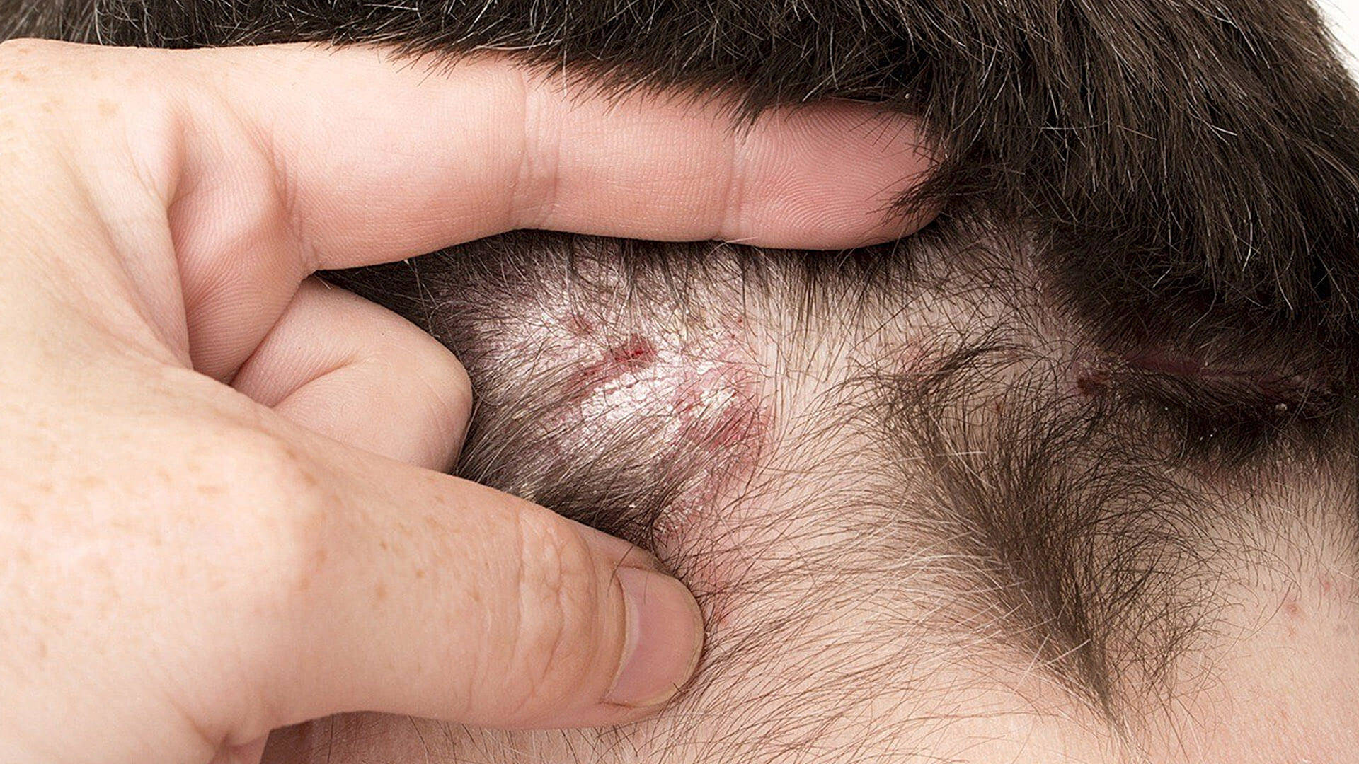 Was ist seborrhoische Dermatitis?