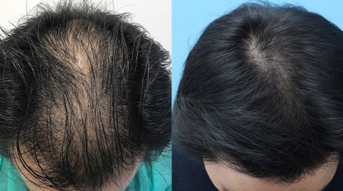 Was ist unrasierte Haartransplantation