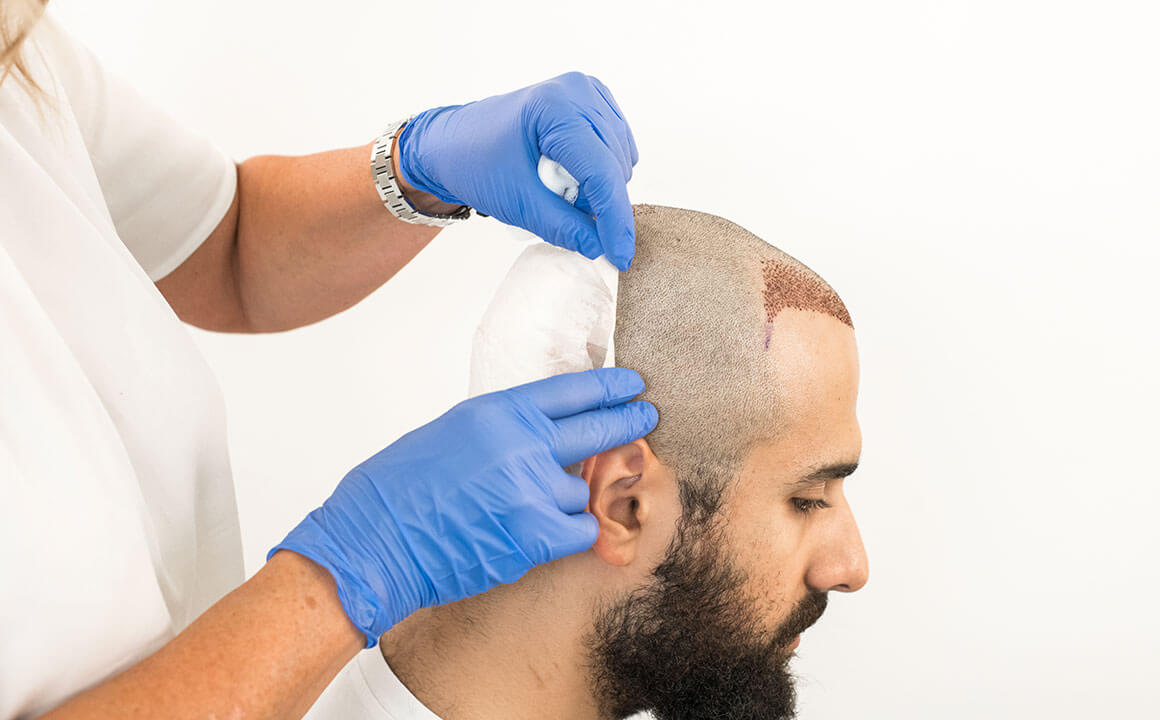 when does numbness go away after ahair transplant