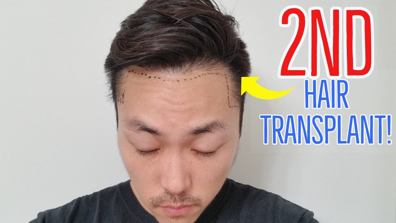 ¿Cuándo es necesario un segundo trasplante de cabello?