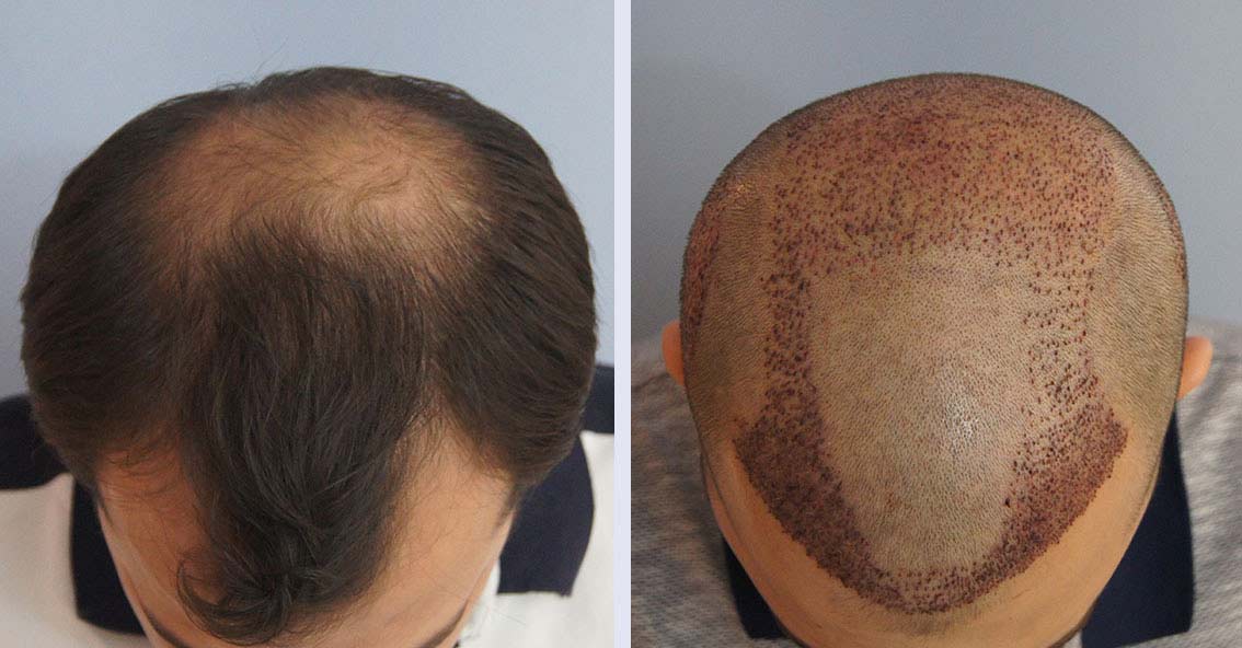 when to get a hair transplant_3