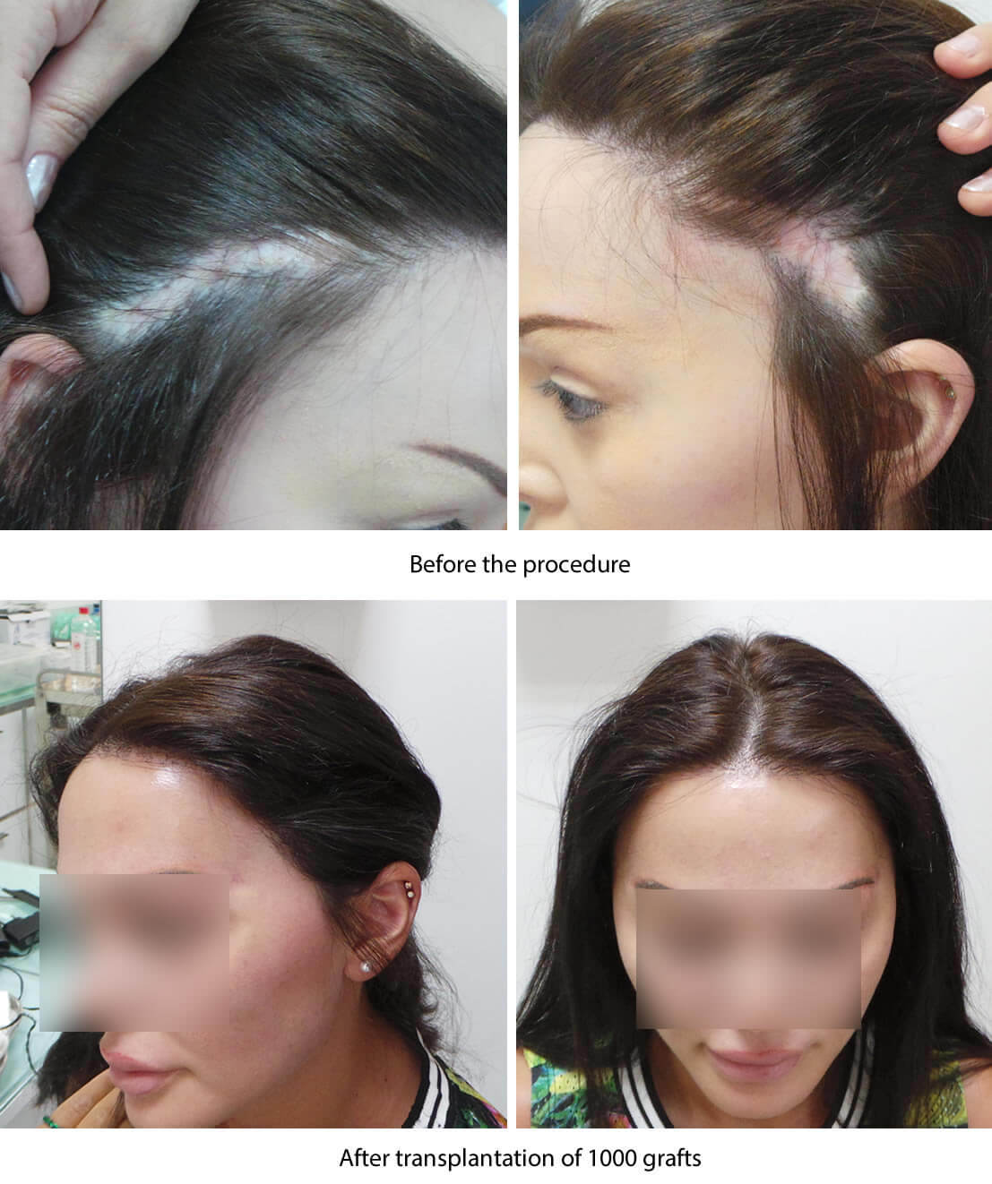 woman hair transplant before after