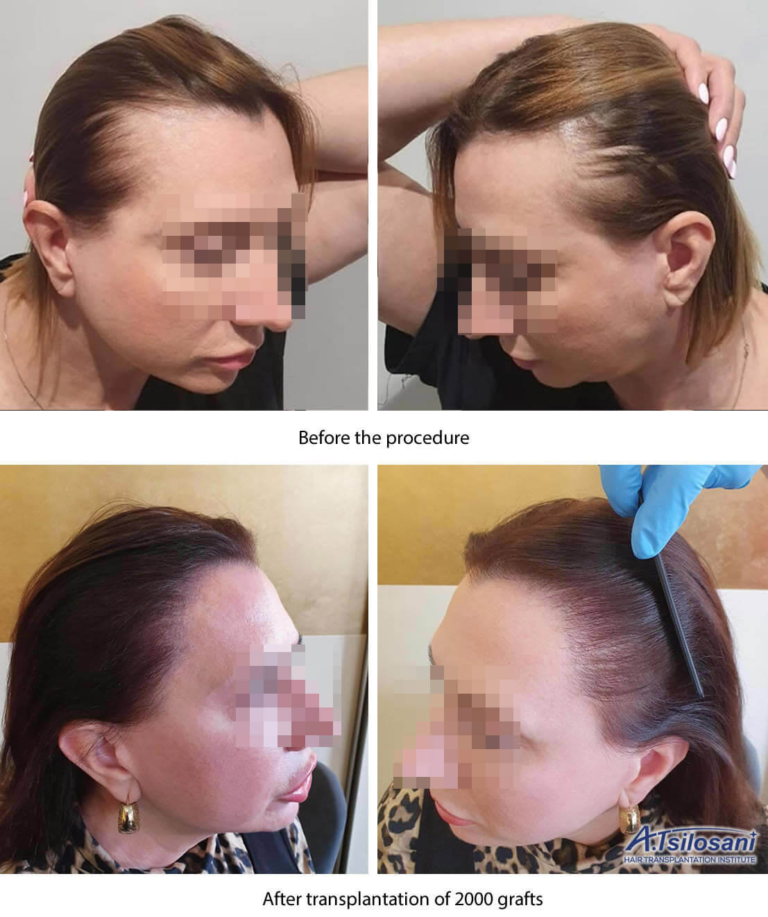 mujer trasplante de cabello antes después de ejemplo