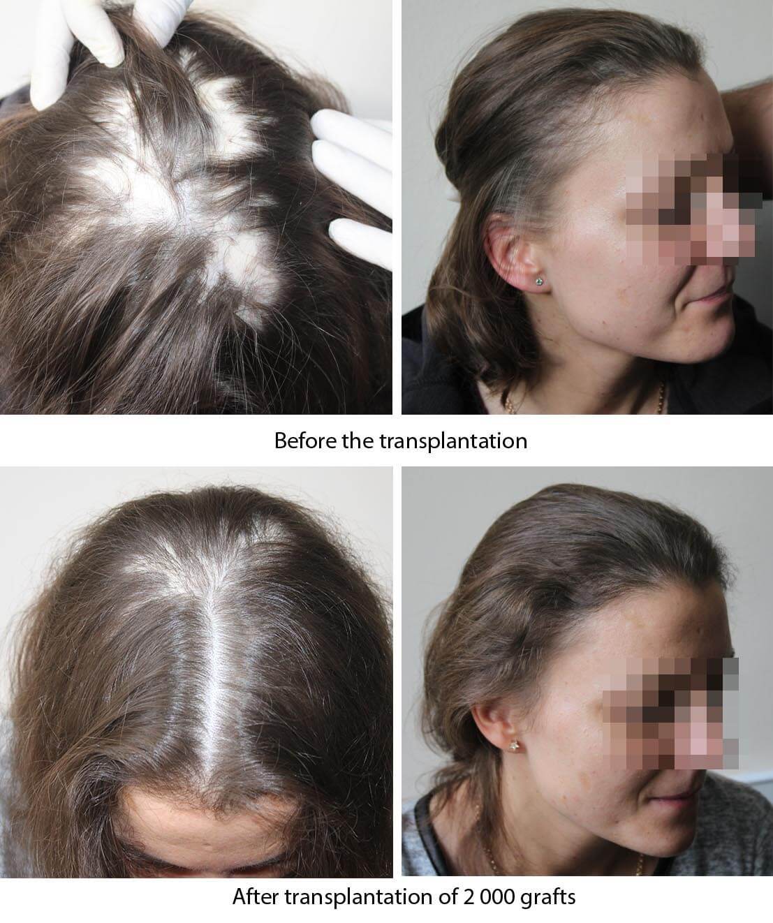 mujer trasplante de cabello antes después