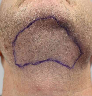 Bart-zu-Kopfhaut-Haartransplantation