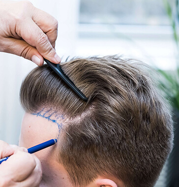 Haarausfall nach Haartransplantation