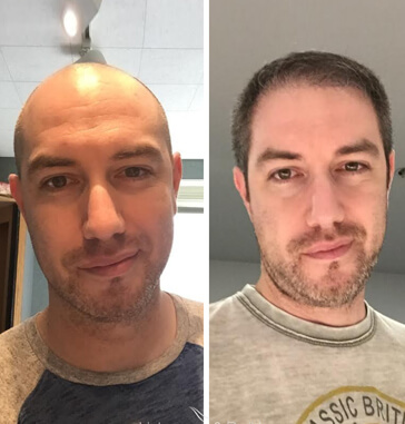 Fotos de antes y después del trasplante de cabello