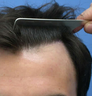 Natürliche Haartransplantation