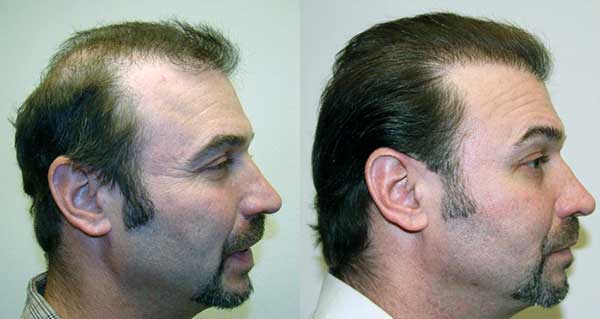 doğal saç ekimi önce ve sonra