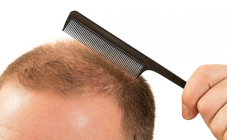 erkeklerde saç dökülmesi