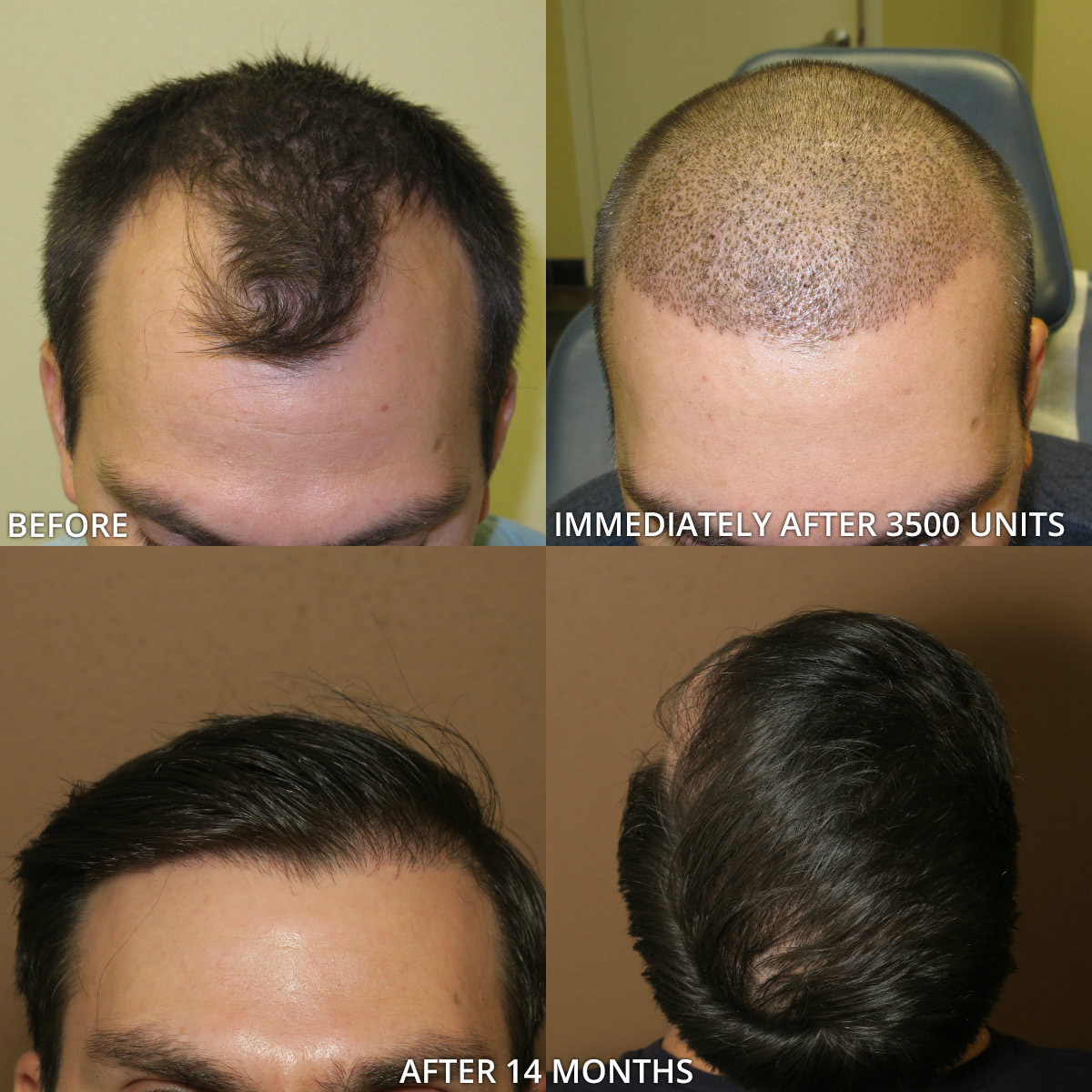 FUE saç ekimi öncesi sonrası sonuçları
