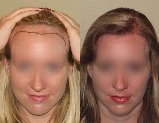kadın saç ekimi önce ve sonra sonucu