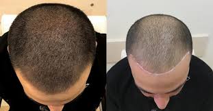 saç simülasyonu yaptırdıktan önce ve sonra