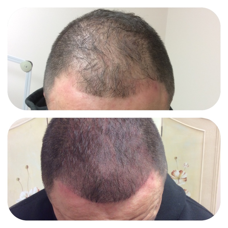 saç simülasyonu ile saç dövmesi öncesi ve sonrası