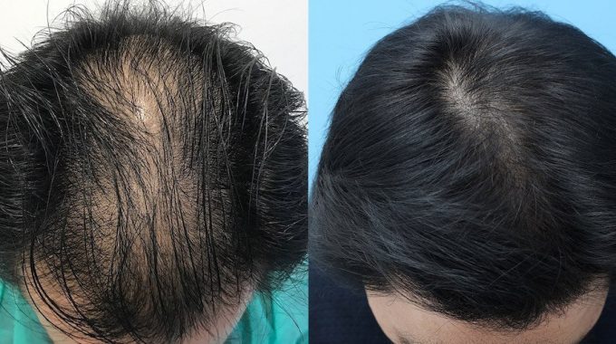 tıraşsız saç ekimi önce ve sonra